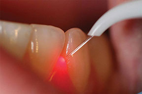 Zdravljenje dlesni z laserjem